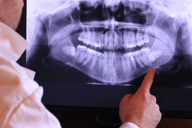 Best Knocked-Out Tooth (Avulsed Tooth) Treatment in Knightsen, CA
