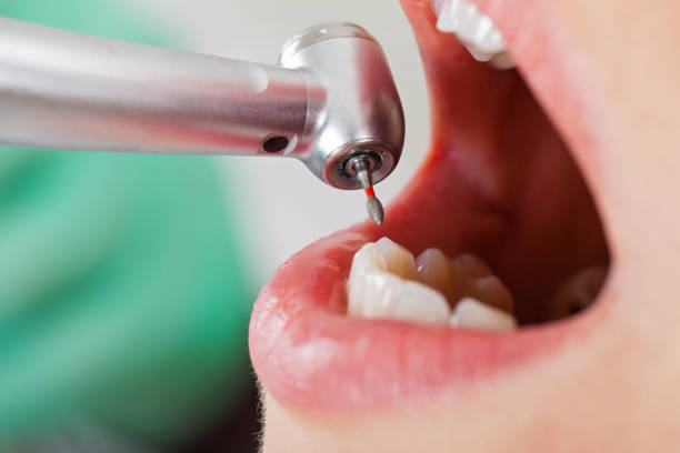 Best Emergency Root Canal Therapy in Knightsen, CA